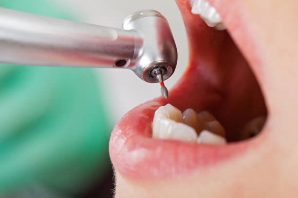 Best Emergency Dental Care for Broken or Chipped Teeth in Sweet Home, AR